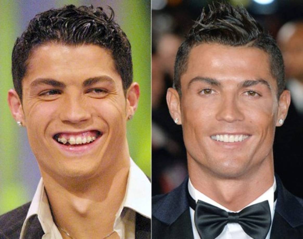 Cristiano Ronaldo se hizo unos cuantos arreglos en los dientes y el especialista dijo que quizás se haya hecho una ortodoncia y hasta tuvo un delicado diseño de sonrisa, lo que si aseguró que sus dientes son reales.