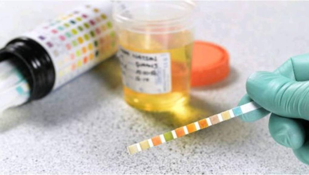 Un análisis de orina podría detectar el cáncer de páncreas temprano, sugiere un estudio