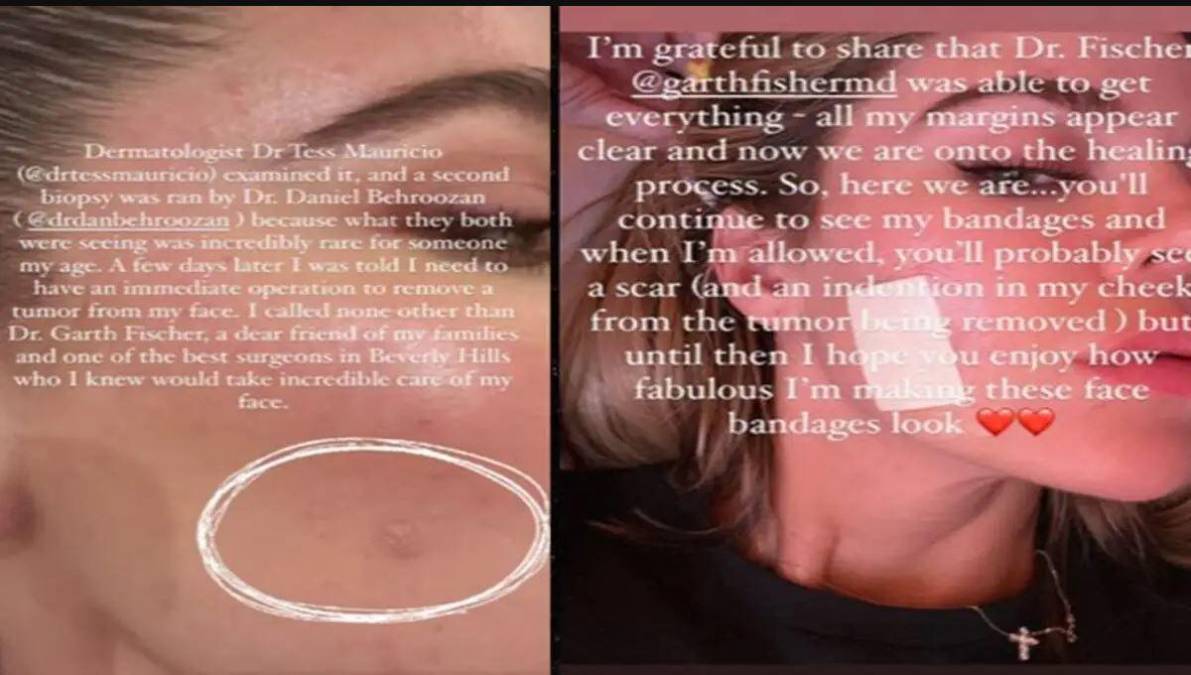 Khloe Kardashian confiesa que le extirparon un tumor de la cara tras sufrir cáncer de piel