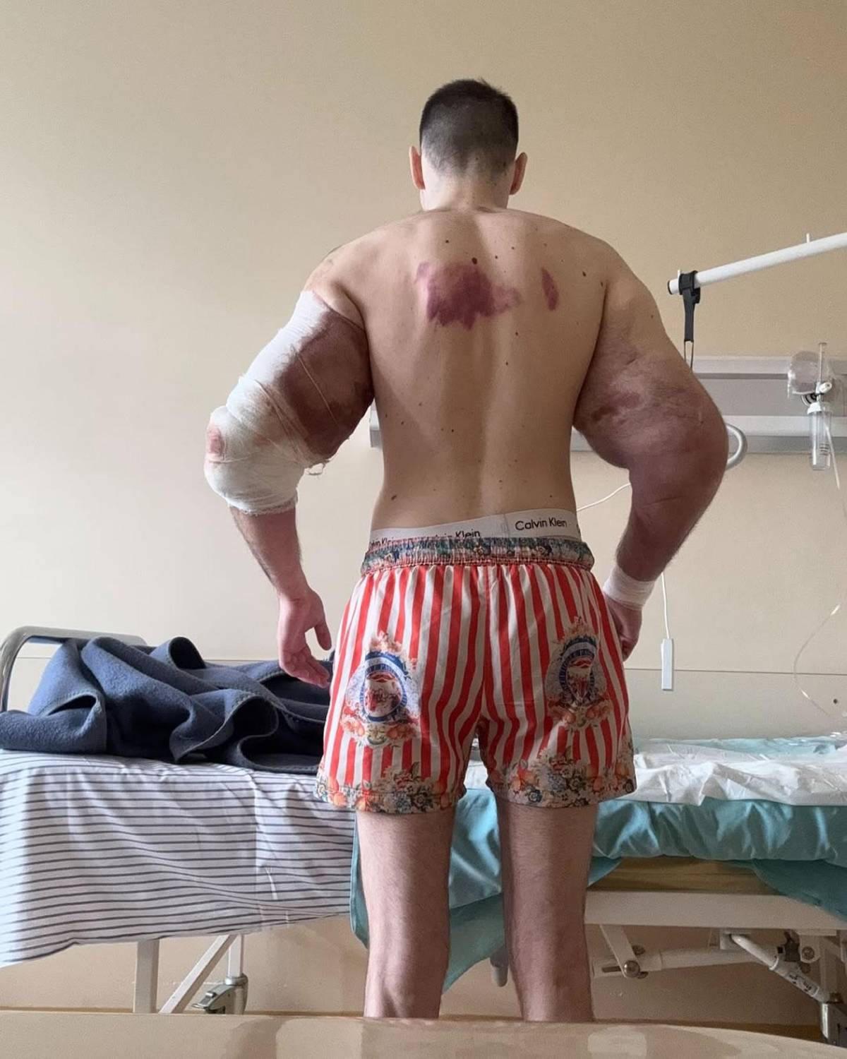 Deportista 'Popeye ruso' hace dramática confesión: podría perder los dos brazos