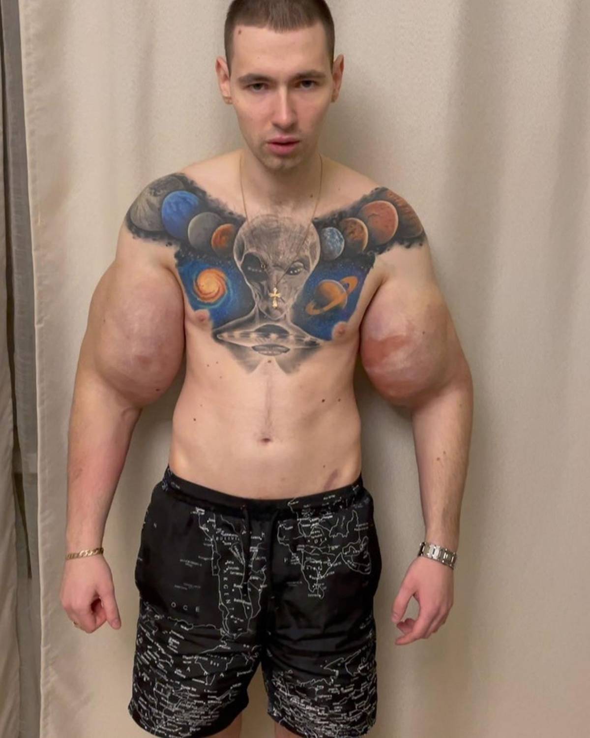 Deportista 'Popeye ruso' hace dramática confesión: podría perder los dos brazos