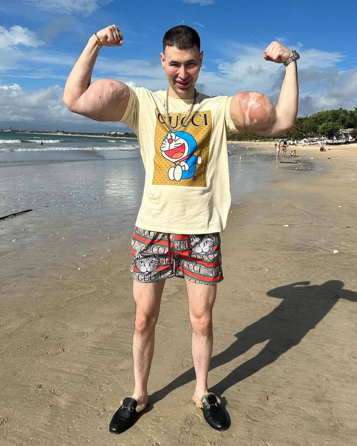 Deportista 'Popeye ruso' hace dramática confesión: podría perder los dos brazos