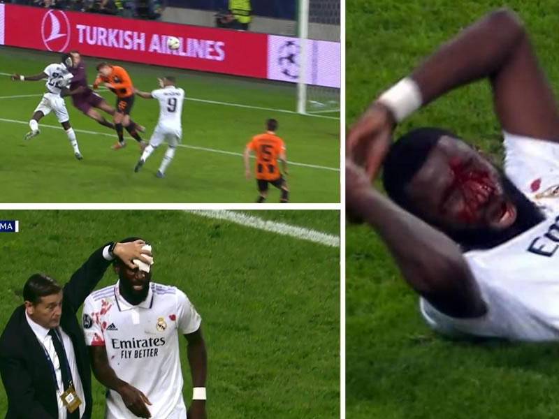 Antonio Rüdiger se llevó un tremendo golpe y corte en su rostro tras marcar el gol del empate del Real Madrid contra el Shakhtar Donetsk.