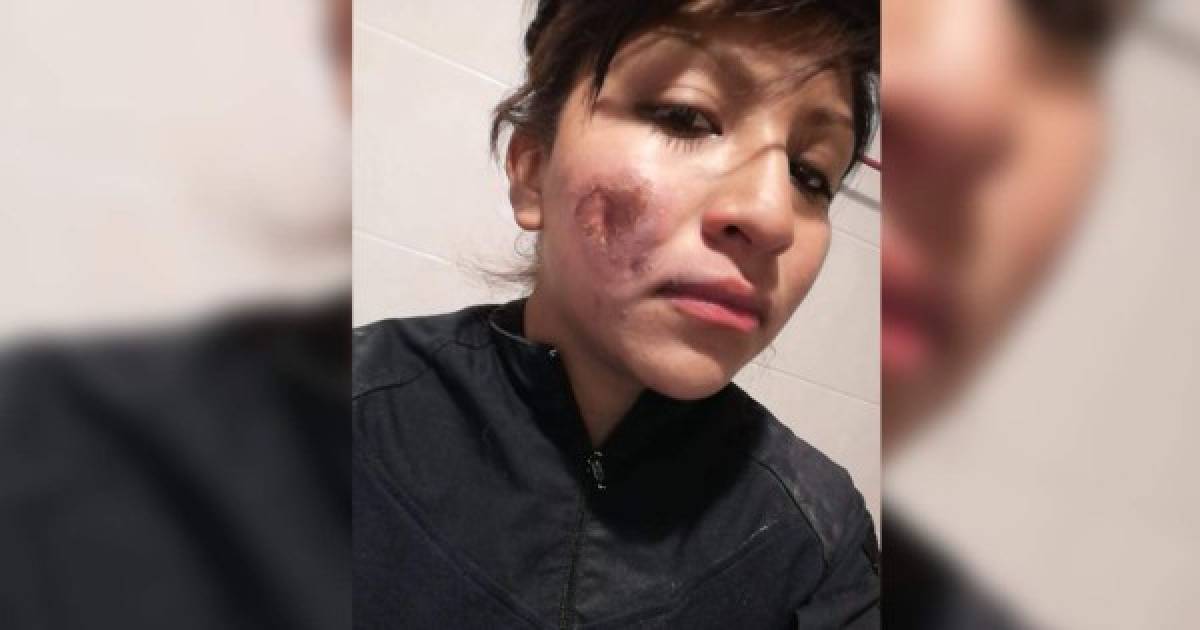 Lucero San Juan, fue víctima de la agresividad de las 'feministas' que marcharon en el 8M, en la ciudad de México. La policía sufrió quemaduras en su rostro y ella mandó un potente mensaje en sus redes sociales. <br/>