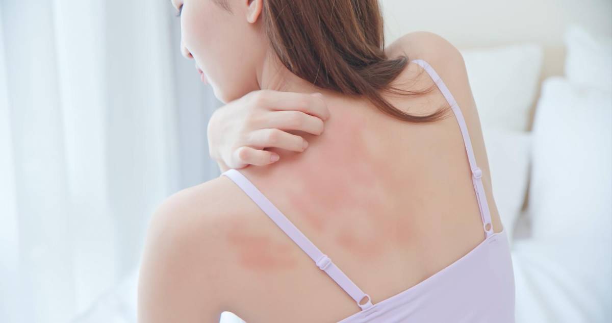 Urticaria, ¿cómo podemos identificarla y prevenirla?