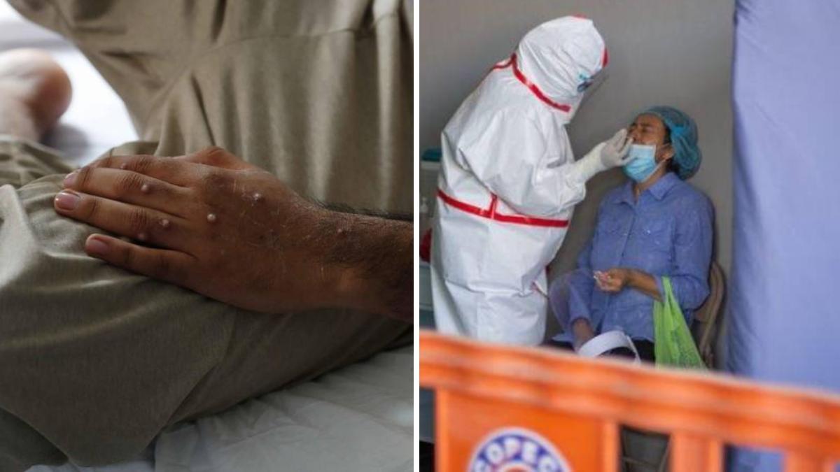 Experto explica la posibilidad de contagio de viruela del mono y covid-19 al mismo tiempo