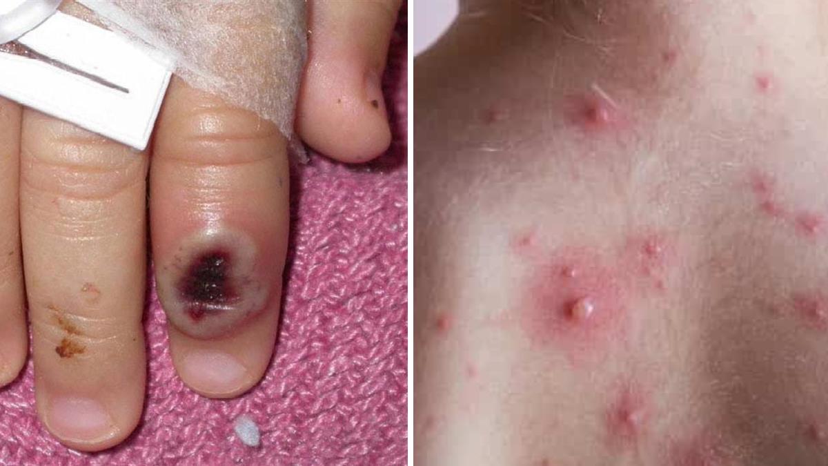 Conozca las diferencias entre la viruela del mono y la varicela