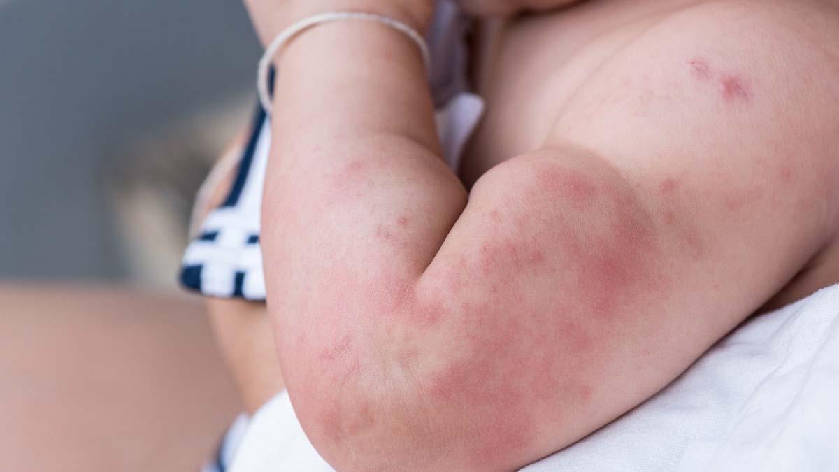 Canadá no descarta que la viruela del mono haya evolucionado y cambiado su forma de contagio. Foto istockphoto