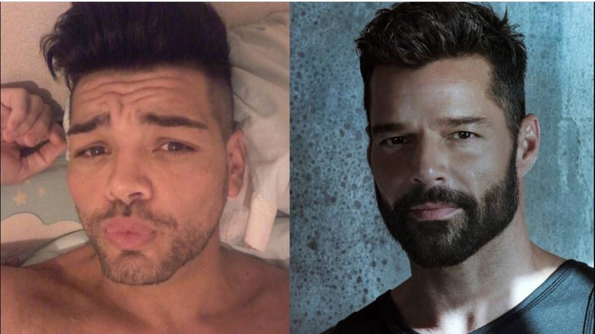 Se practica 30 cirugías para parecerse a Ricky Martin