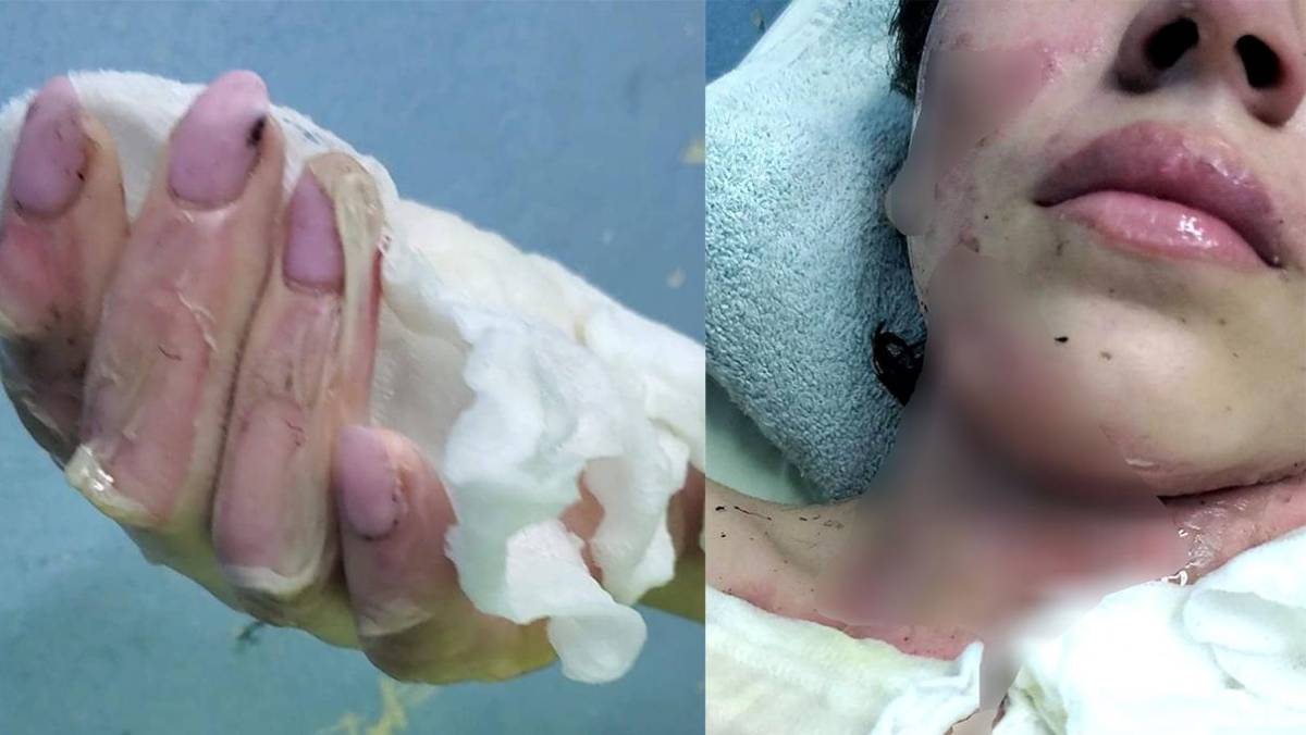 Niña se quema en feria de ciencia, su hermano la auxilió y también salió con quemaduras