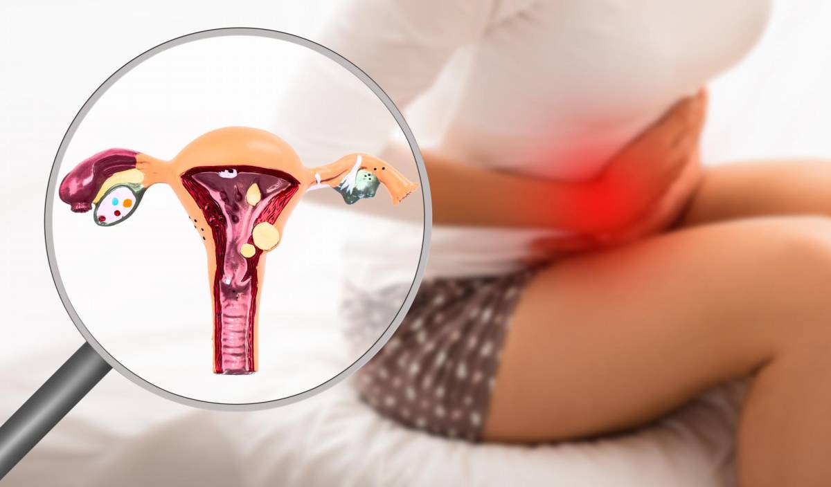 Endometriosis, una dolorosa afección que ataca a las mujeres