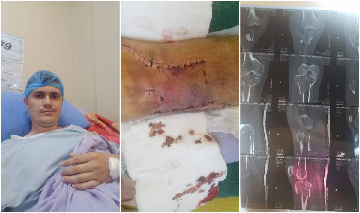 Francisco Peña tendrá que someterse a un caro tratamiento.