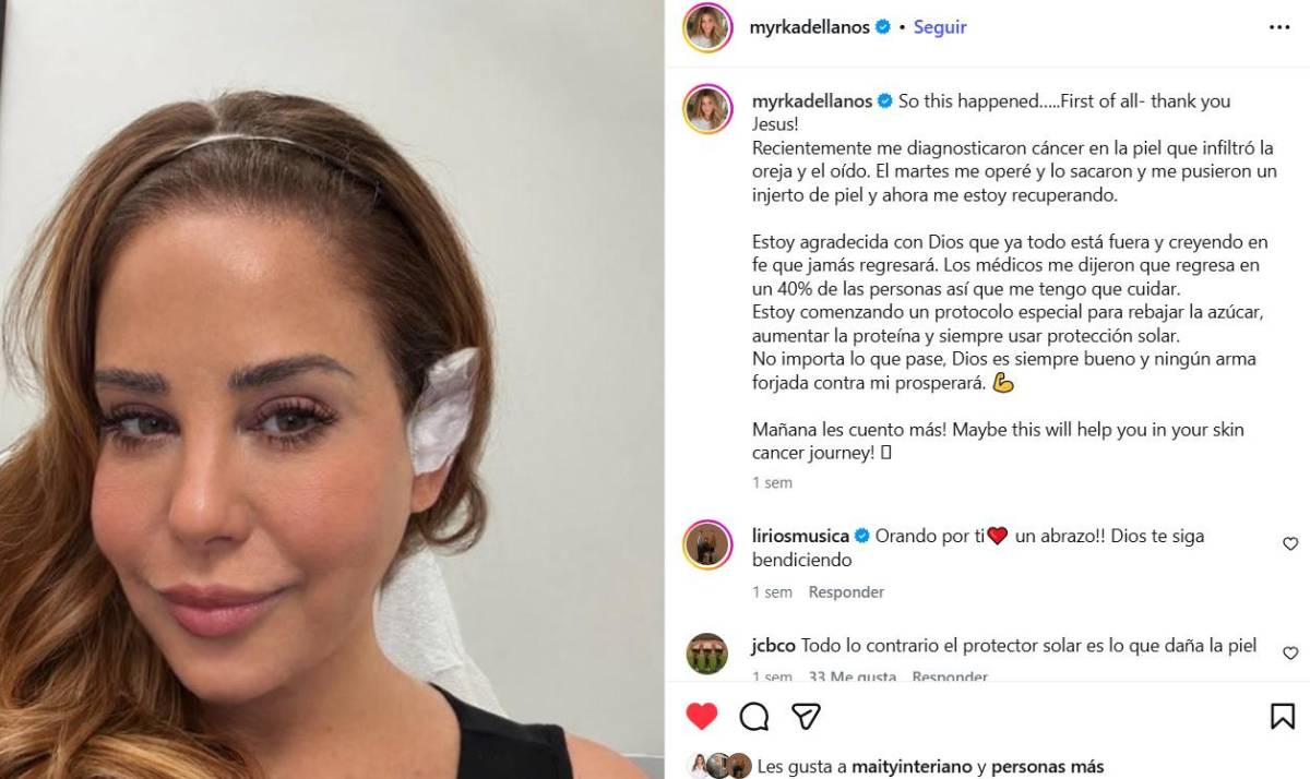 Myrka Dellanos se sometió a una cirugía por cáncer de piel