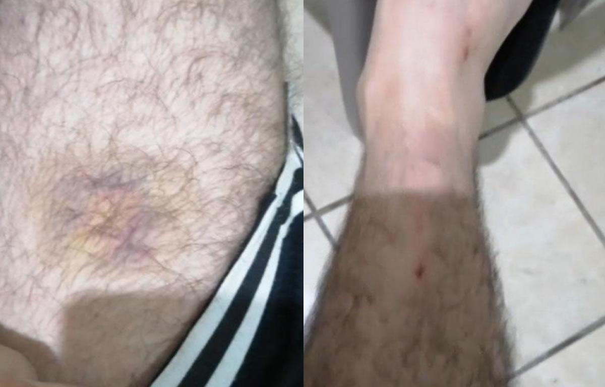 Los golpes que recibió Gilbert Reyes.