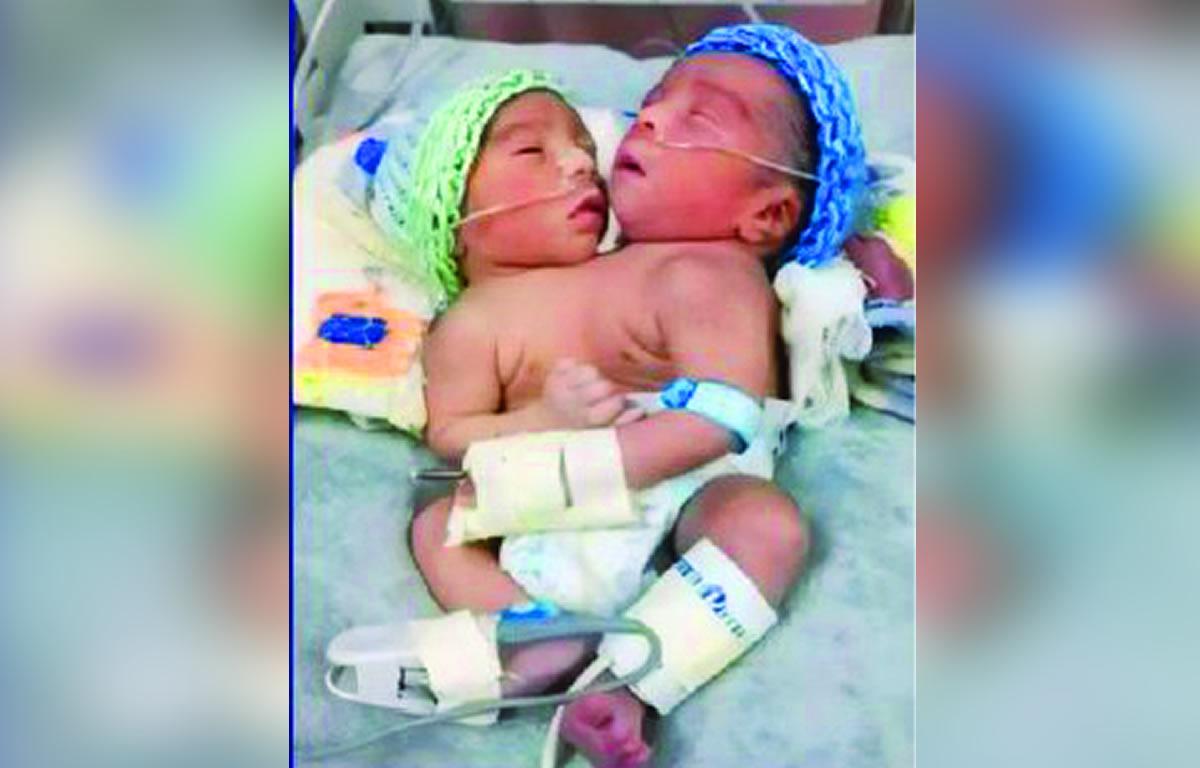 Un corazón, dos vidas: bebés siameses nacen en hospital de Comayagua
