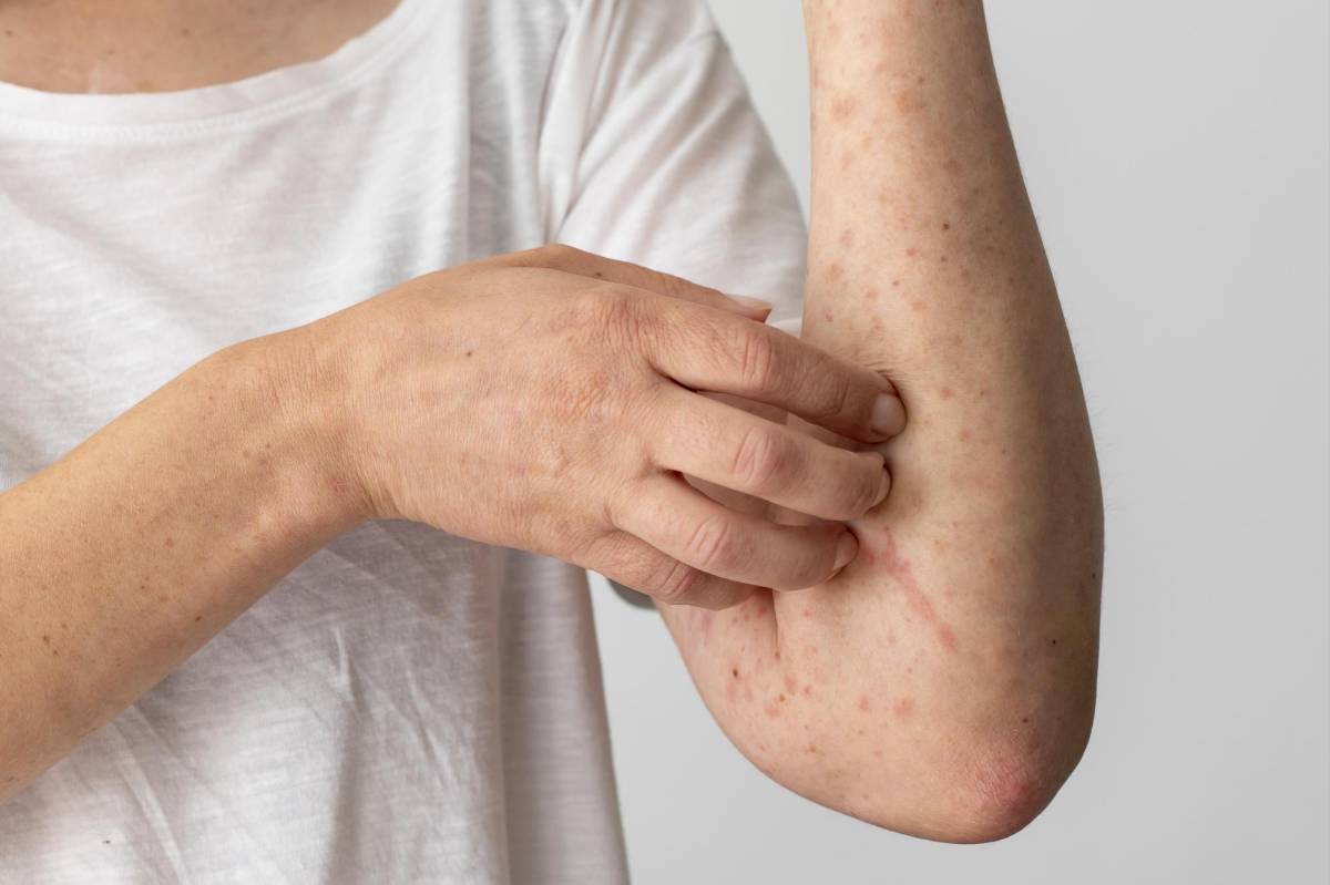 Eczema o psoriasis, ¿cómo notar las diferencias?