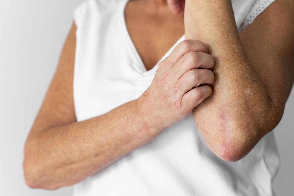 La enfermedad reumatológica se puede manifestar en la piel