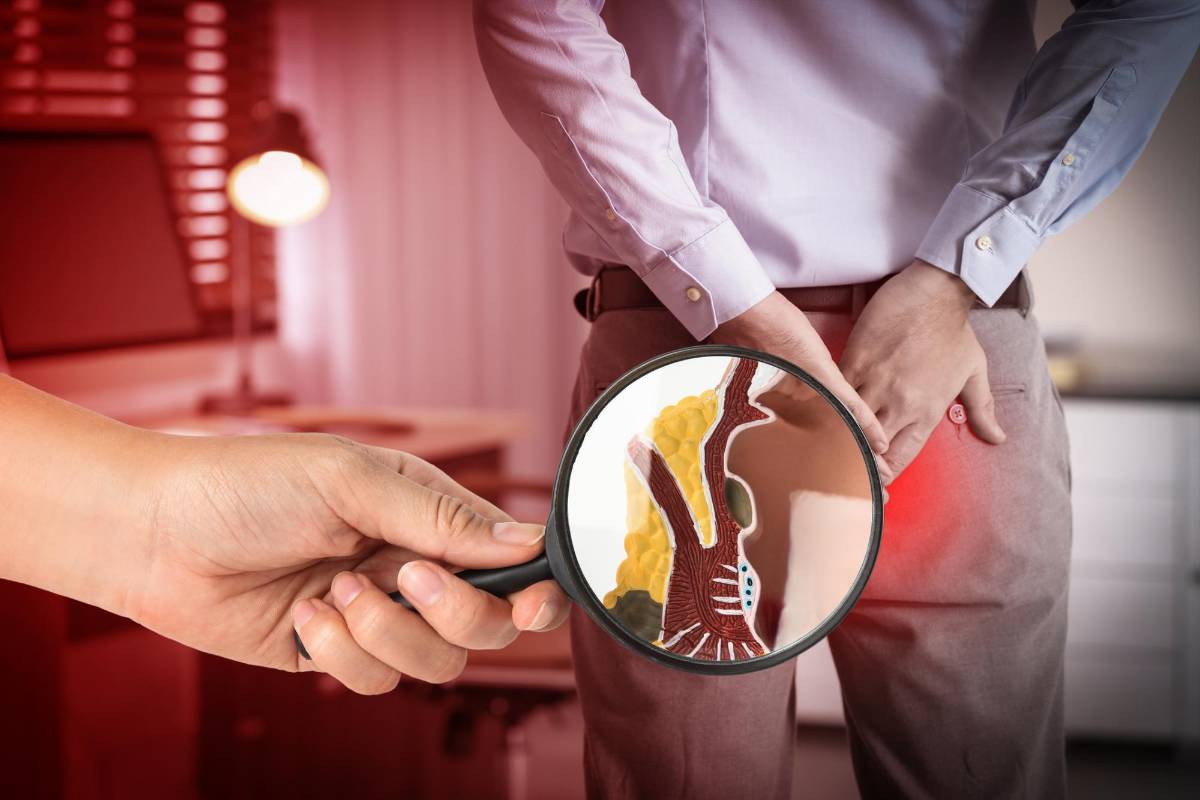 Cáncer de colon suele confundirse con hemorroides