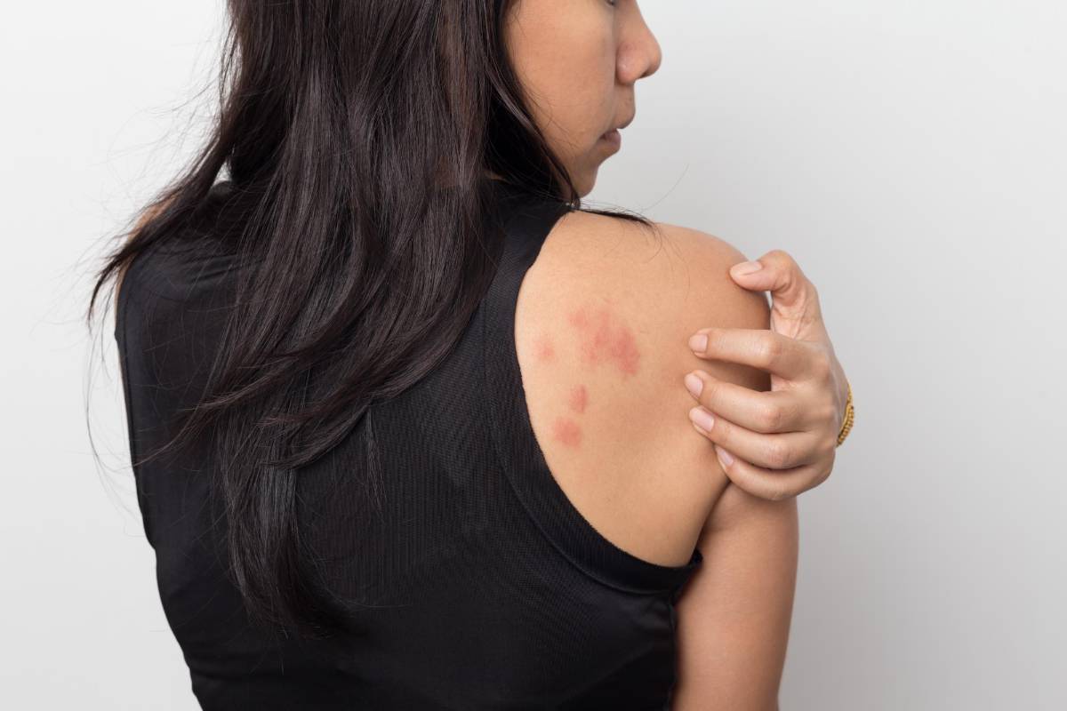 Urticaria, ¿cómo podemos identificarla y prevenirla?