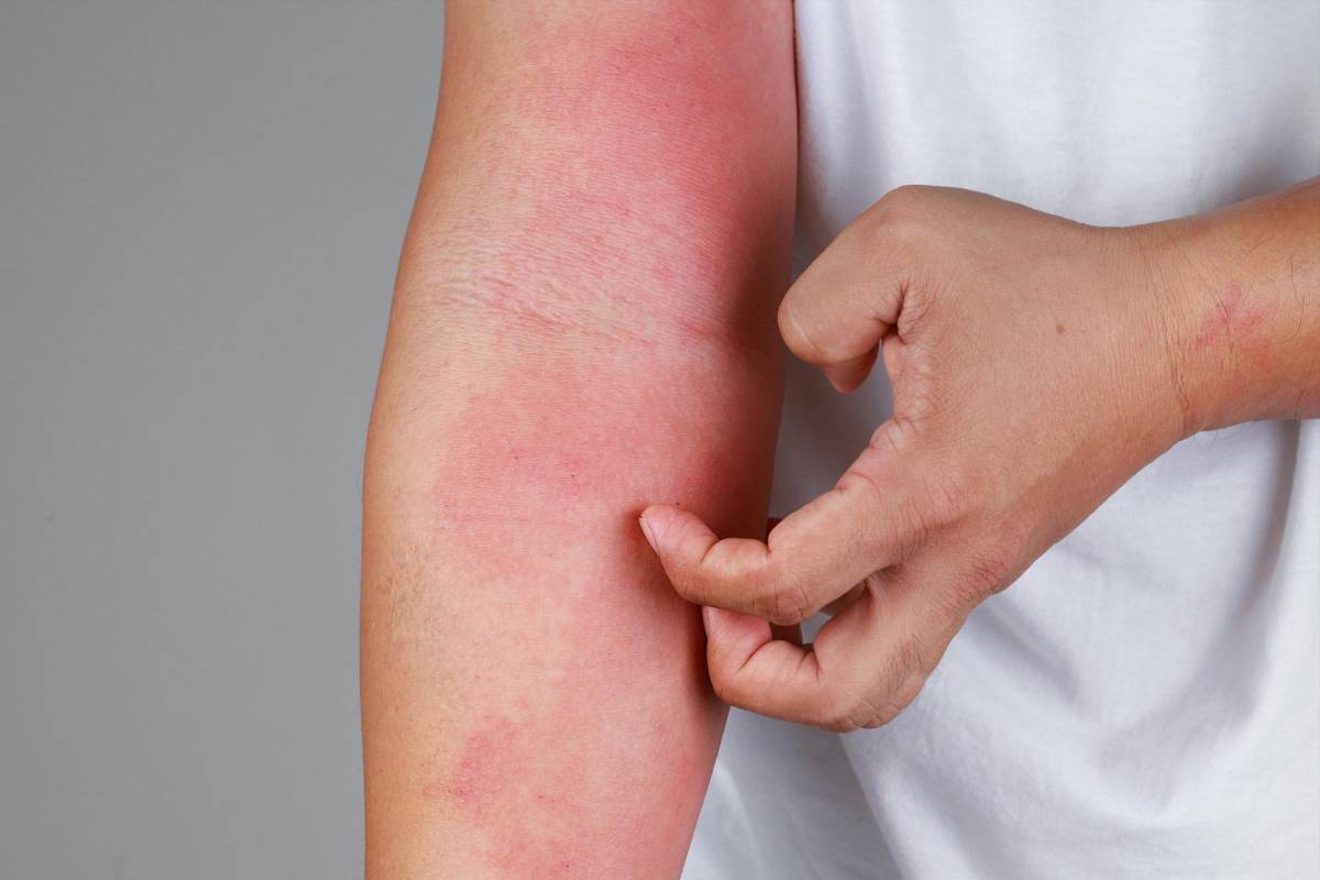 ¿Cómo detectar y tratar la dermatitis atópica?