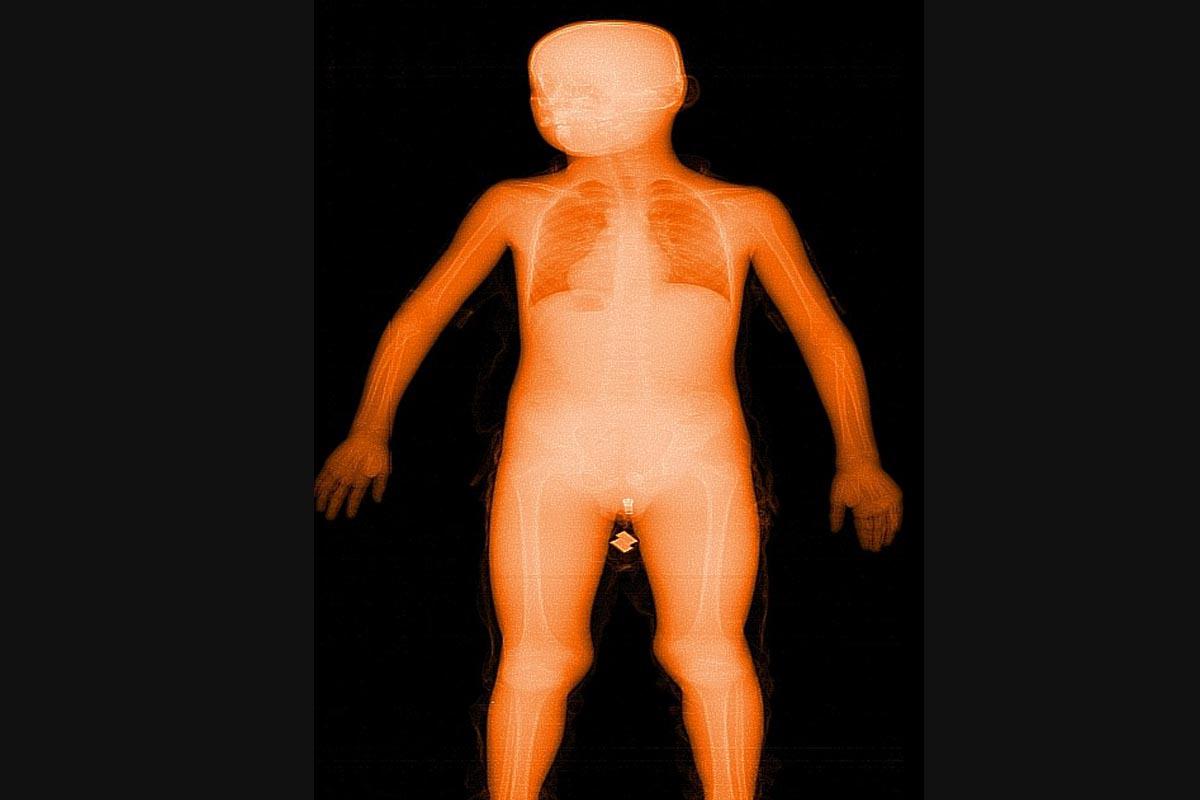 Imagen de rayo X de Anny Jackelyne.