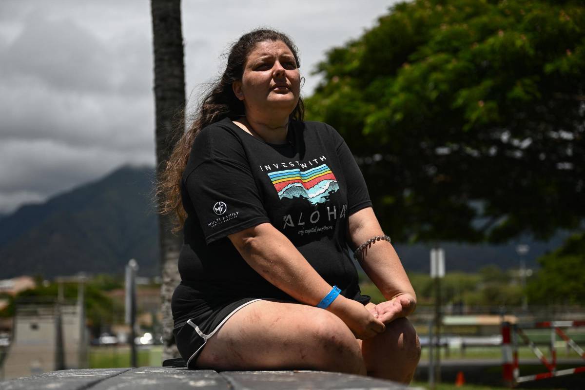 Annelise Cochran muestra las quemaduras y cicatrices en su cuerpo tras su milagroso escape de las llamas.