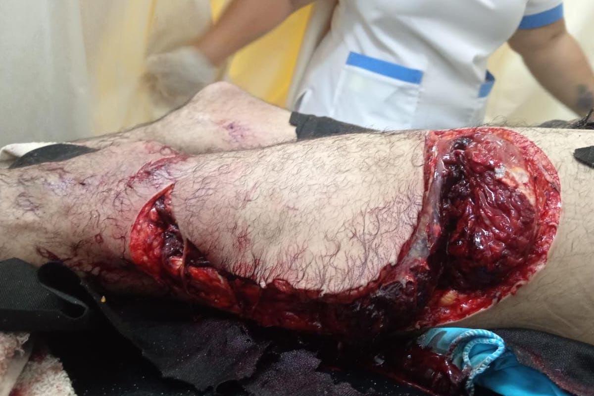 Mordida del tiburón en la pierna del hondureño.