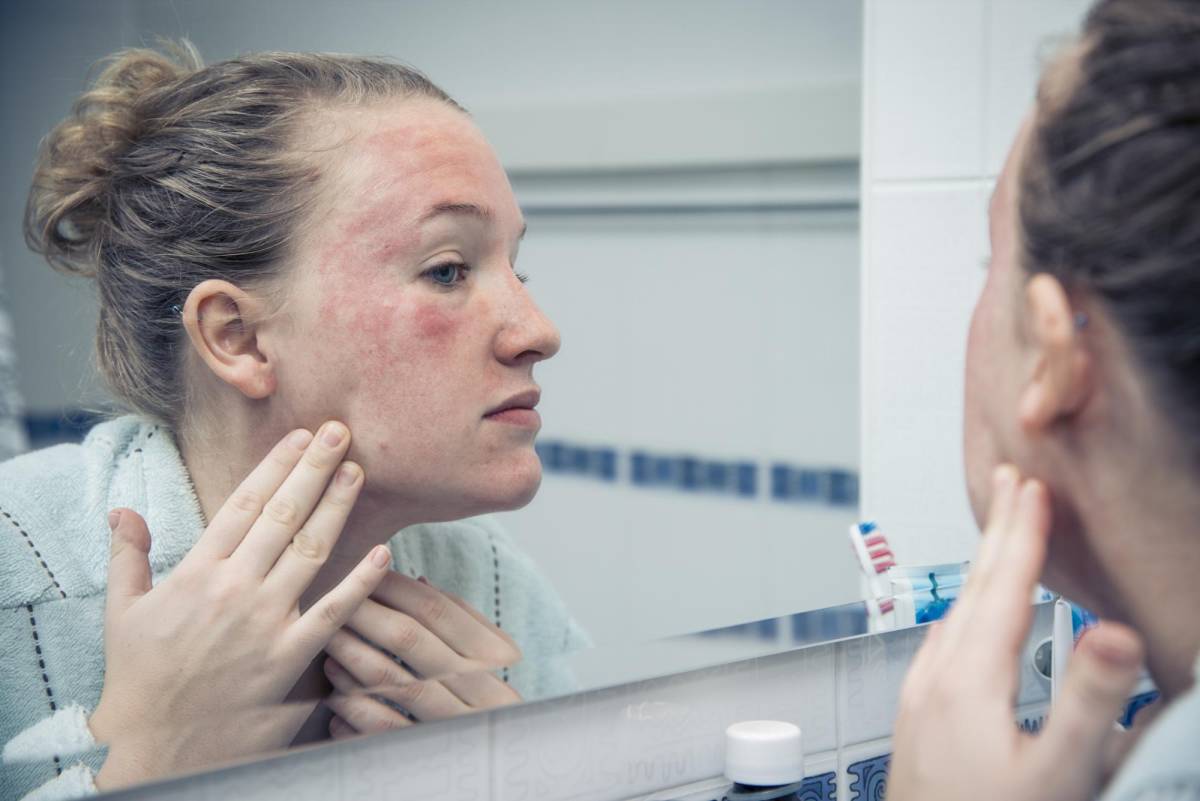 ¿Cómo detectar y tratar la dermatitis atópica?
