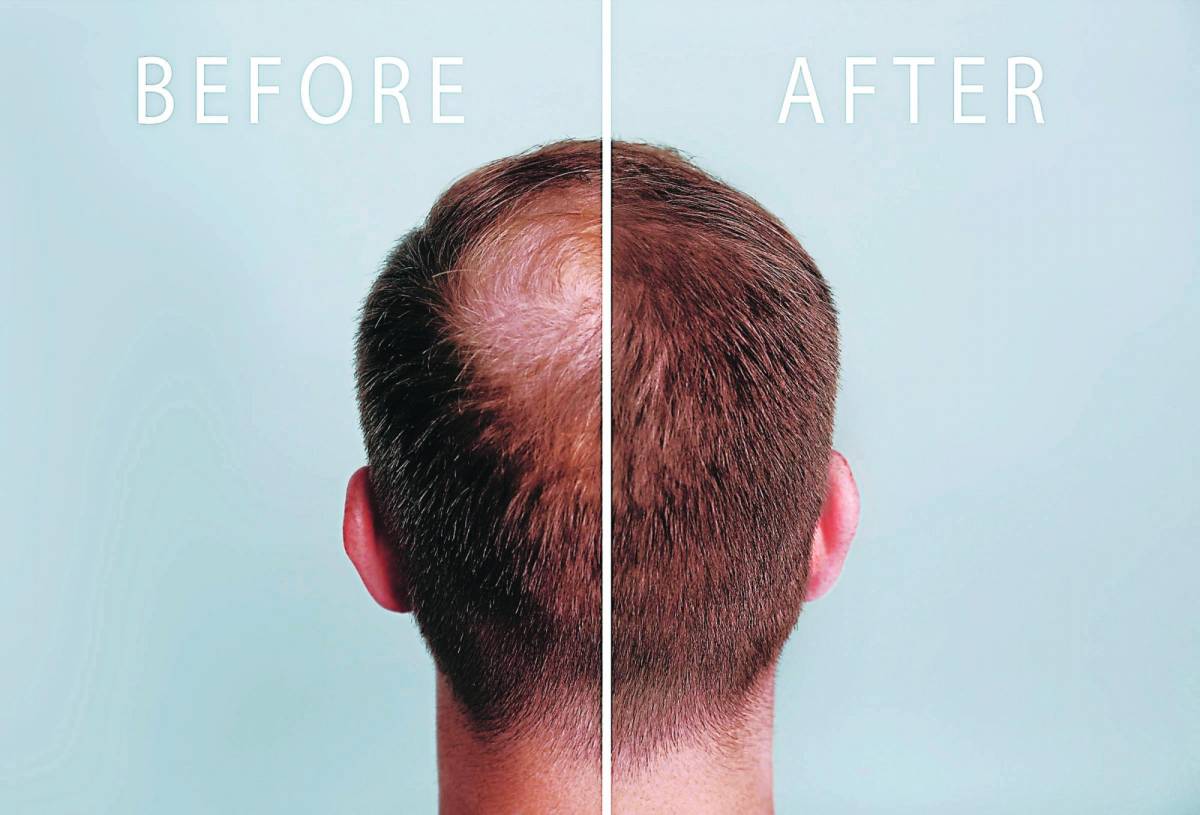 Tratamientos efectivos para combatir la alopecia
