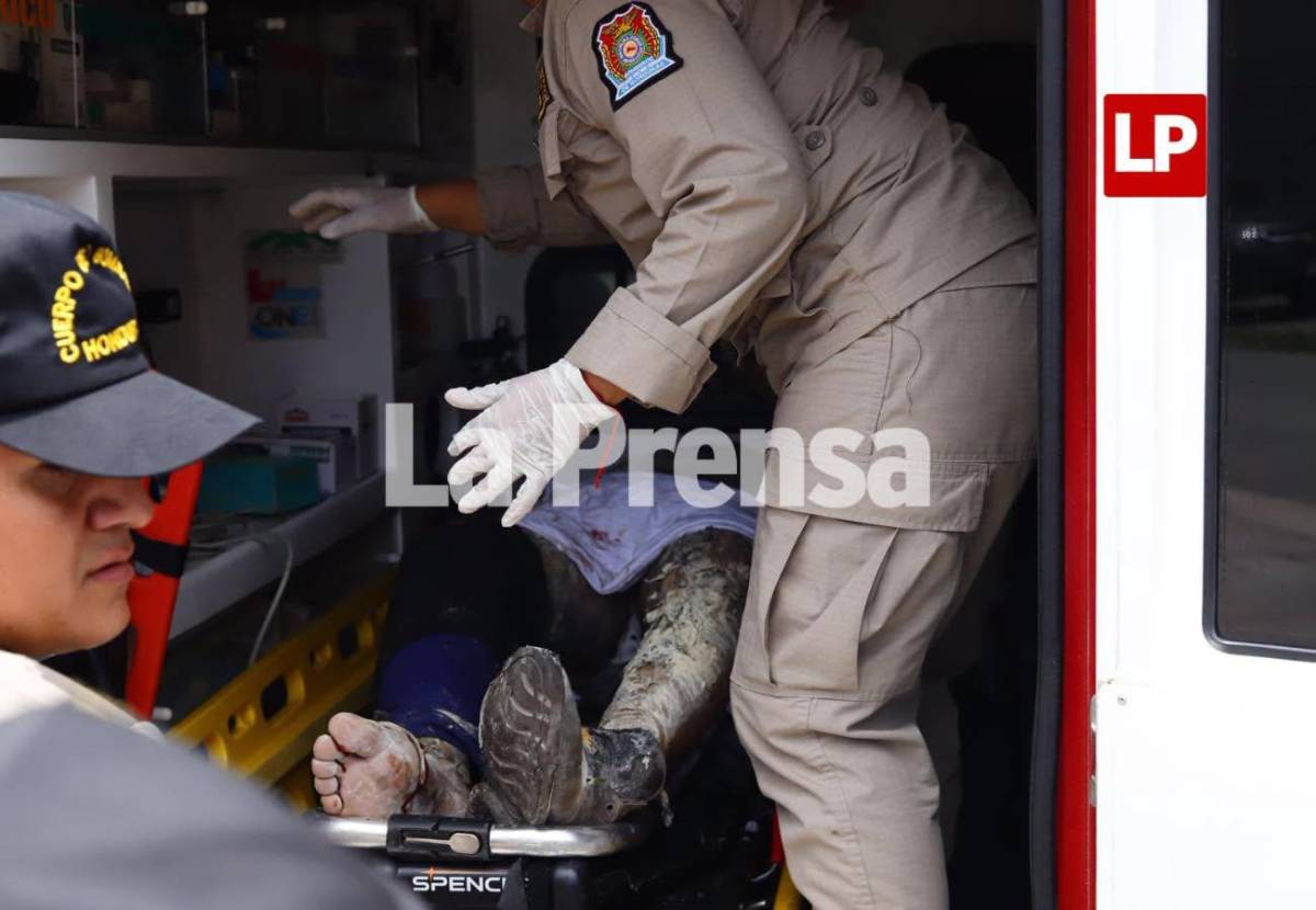 Conductor de moto que incendió bus en San Pedro Sula está en UCI con pronóstico reservado