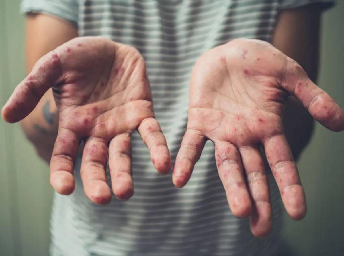 Cuatro miembros de una familia en San Pedro Sula dan positivo a sarampión