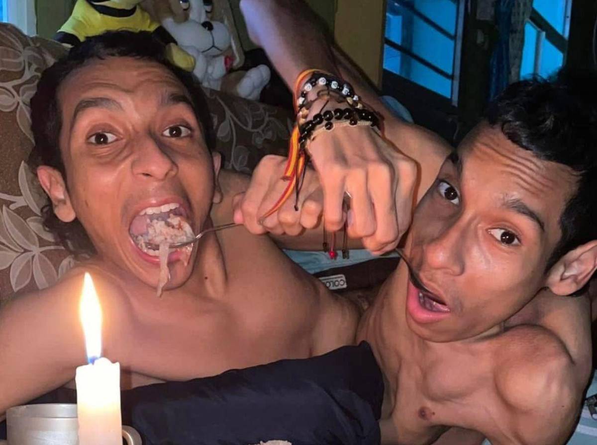 Mueren los hermanos siameses José Luis y José Armando Ceballos