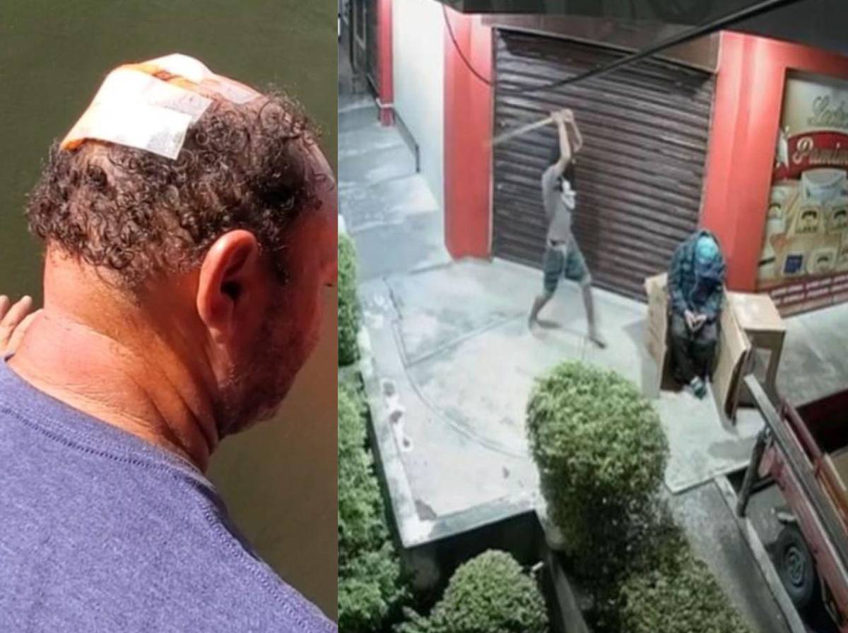 A don Walter le hicieron 14 puntadas en la cabeza y cuatro en la nariz tras brutal agresión