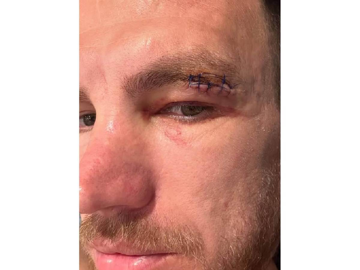 ¡Terrible! Sufrió brutal patada en partido y revela cómo le quedó el rostro