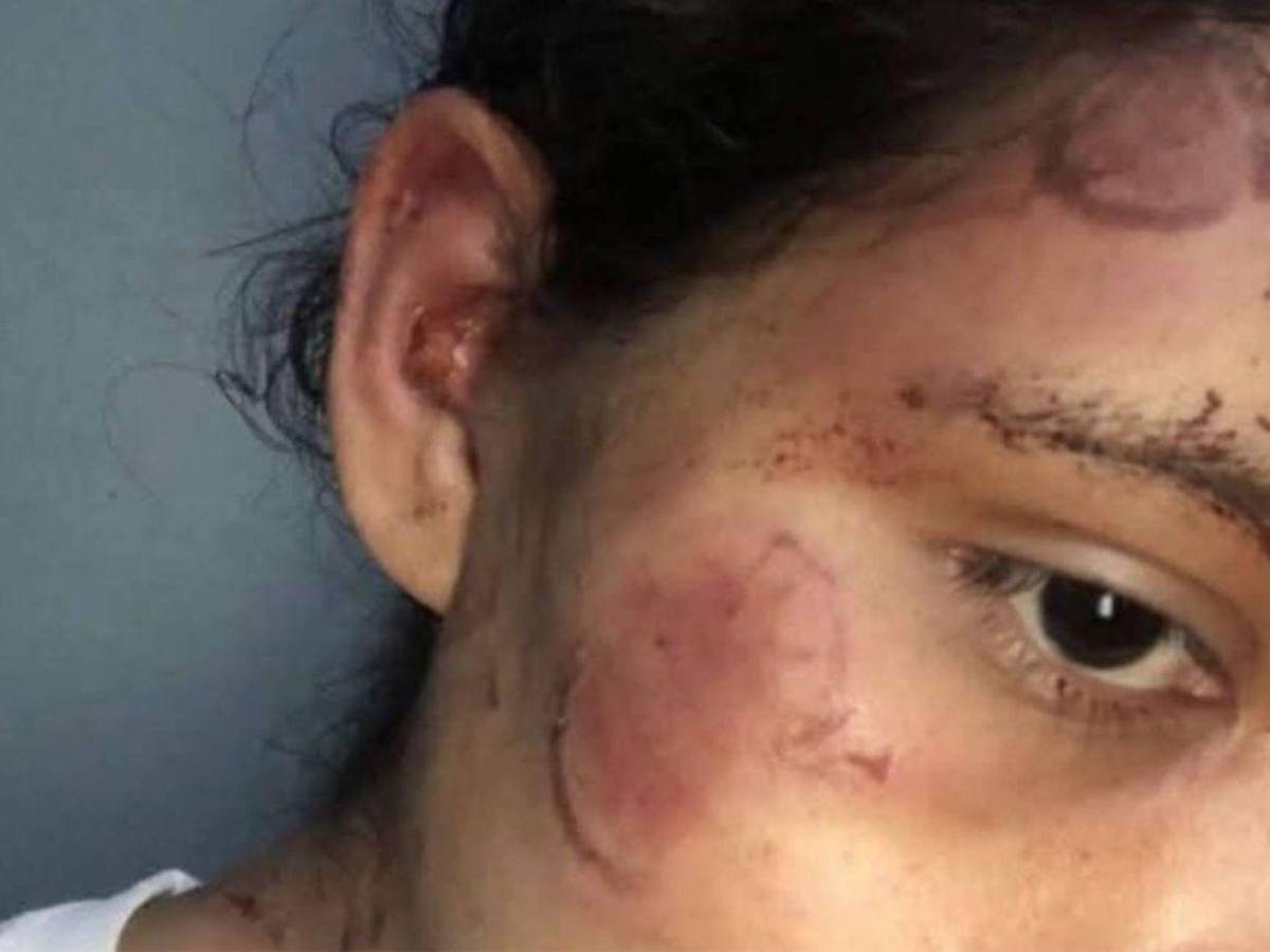 Como si fuera un pitbull: Hombre ataca a mordidas a su pareja en Olancho