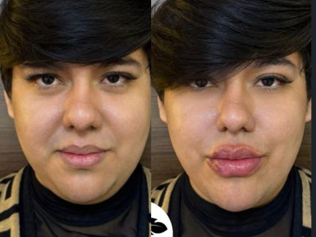 Antonio Sandrez presume sus nuevos labios: “Atáquense y admiren