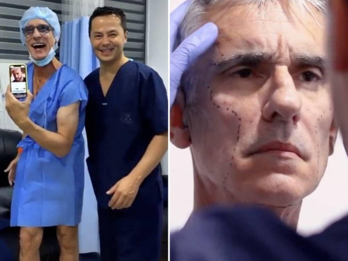 Antes y después del actor de Pedro el Escamoso, Miguel Varoni tras cirugía