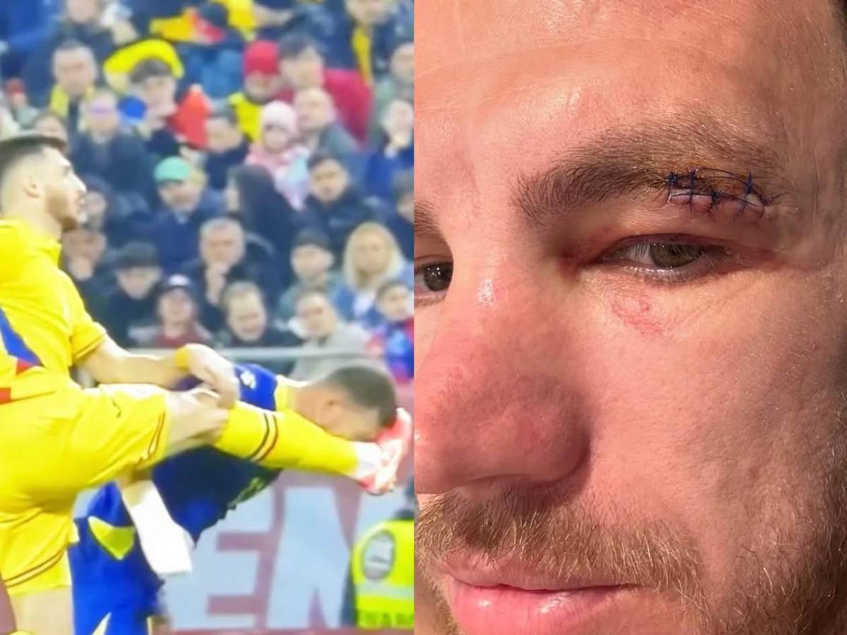 ¡Terrible! Sufrió brutal patada en partido y revela cómo le quedó el rostro