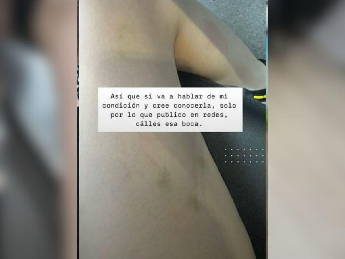 Jennifer Aplícano muestra moretones en su cuerpo y responde a críticas