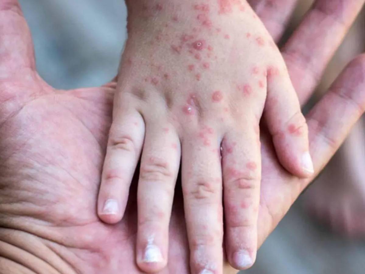 Cuatro miembros de una familia en San Pedro Sula dan positivo a sarampión