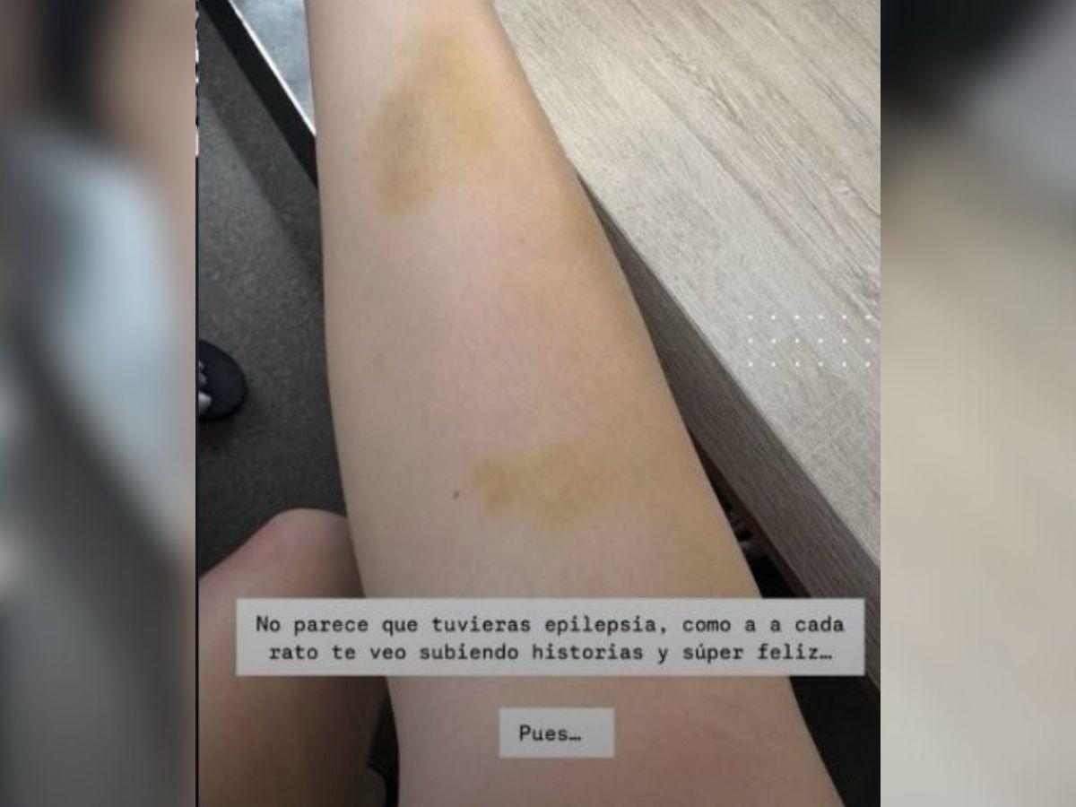 Jennifer Aplícano muestra moretones en su cuerpo y responde a críticas