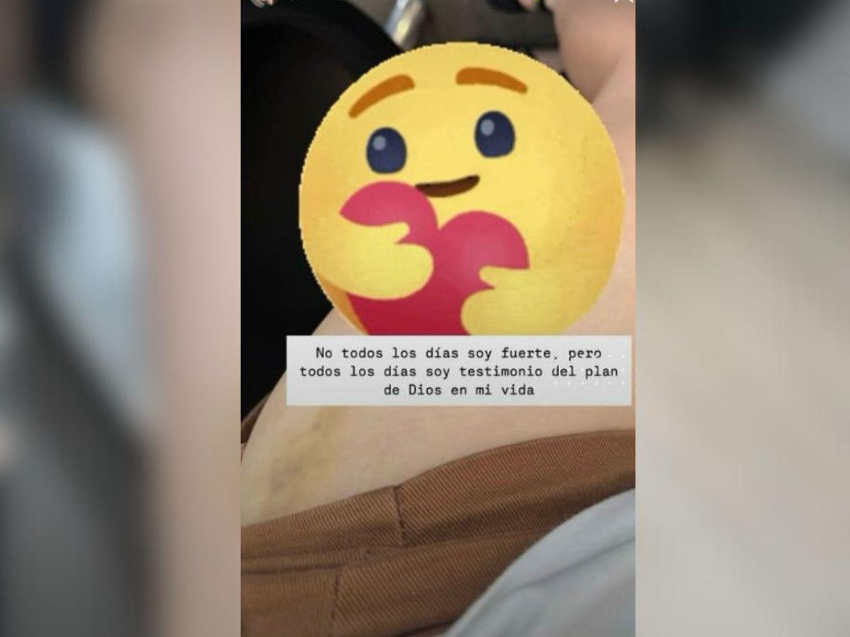 Jennifer Aplícano muestra moretones en su cuerpo y responde a críticas