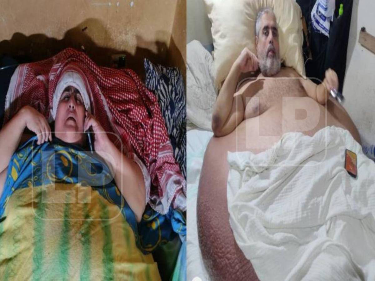 ¿Qué fue de Basima y Nasser Hilsaca, los hermanos más obesos de Honduras?