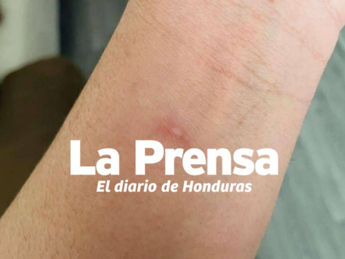 Hondureña casi pierde un brazo en centro de ICE: fue detenida dos semanas después de casarse