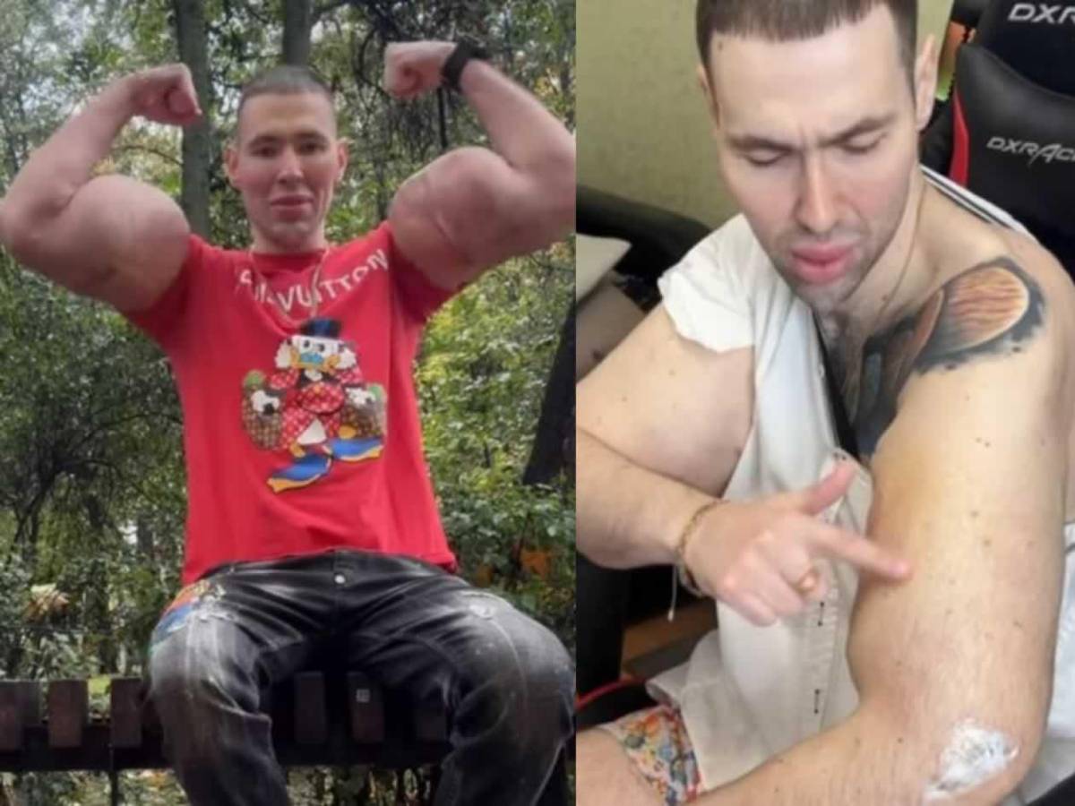 Deportista 'Popeye ruso' hace dramática confesión: podría perder los dos brazos