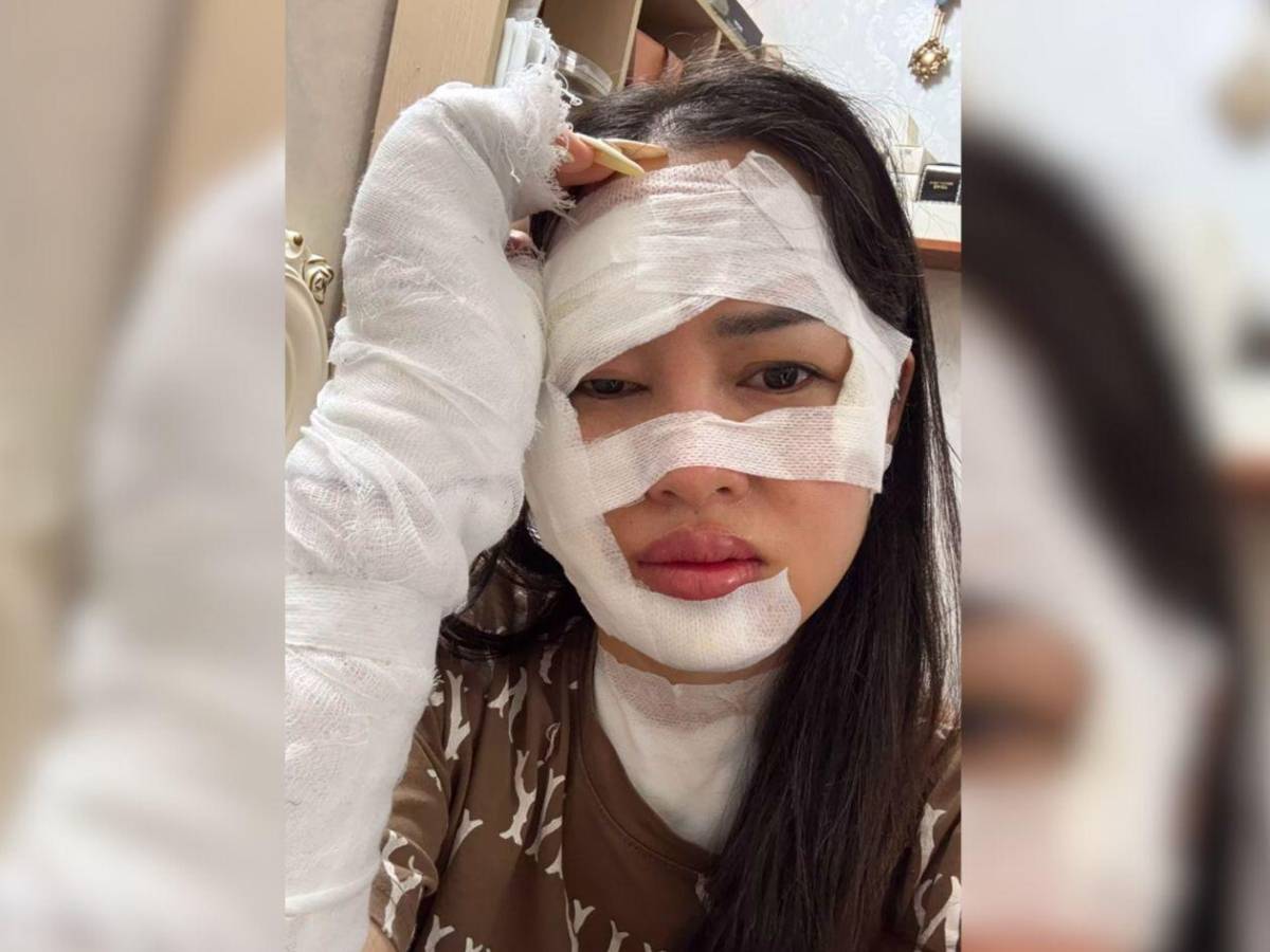 Cumpleaños fatal: Joven se incendia el rostro al rozar velas con globo de helio