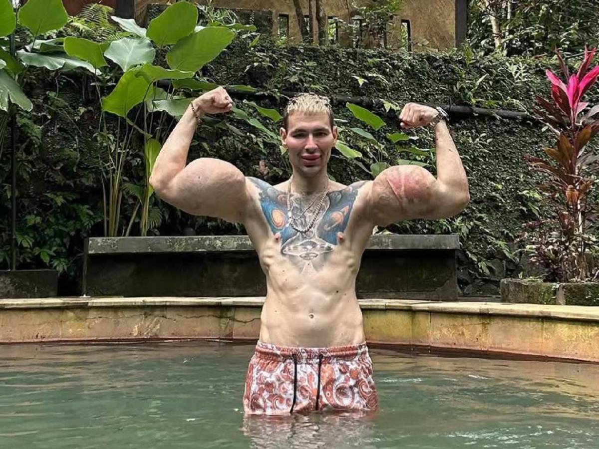 Deportista 'Popeye ruso' hace dramática confesión: podría perder los dos brazos