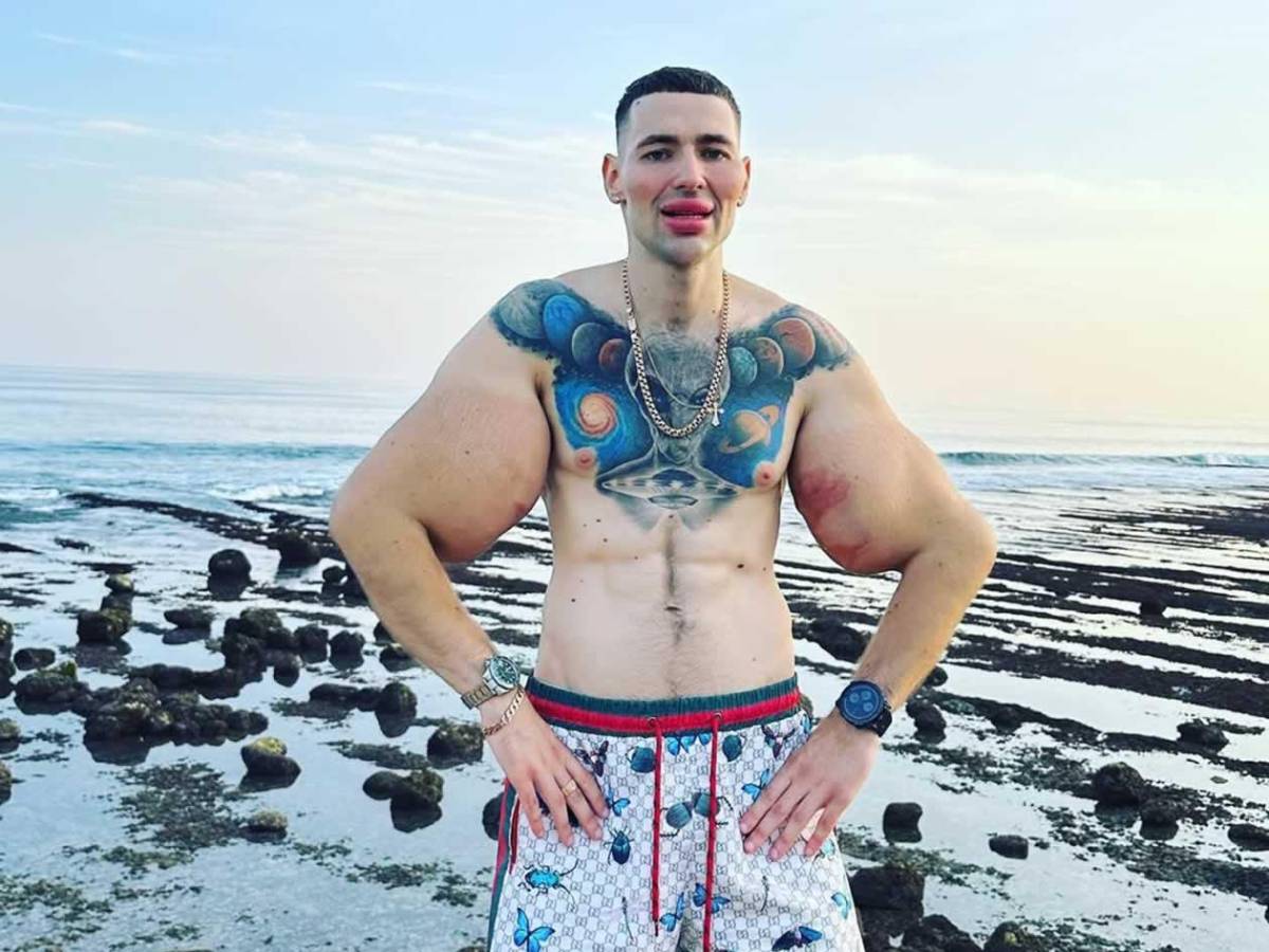 Deportista 'Popeye ruso' hace dramática confesión: podría perder los dos brazos