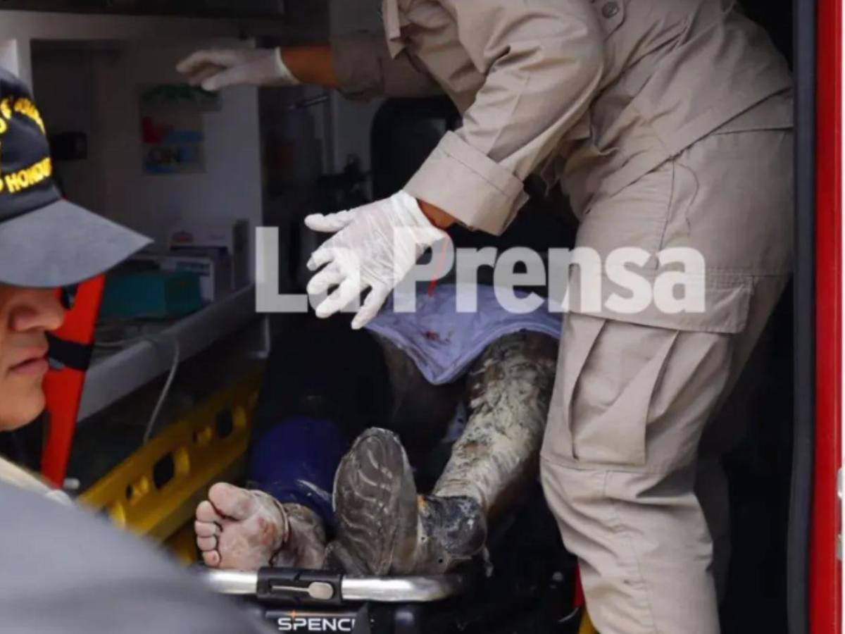 Revelan el estado clínico del hombre que sufrió quemaduras tras accidente en SPS