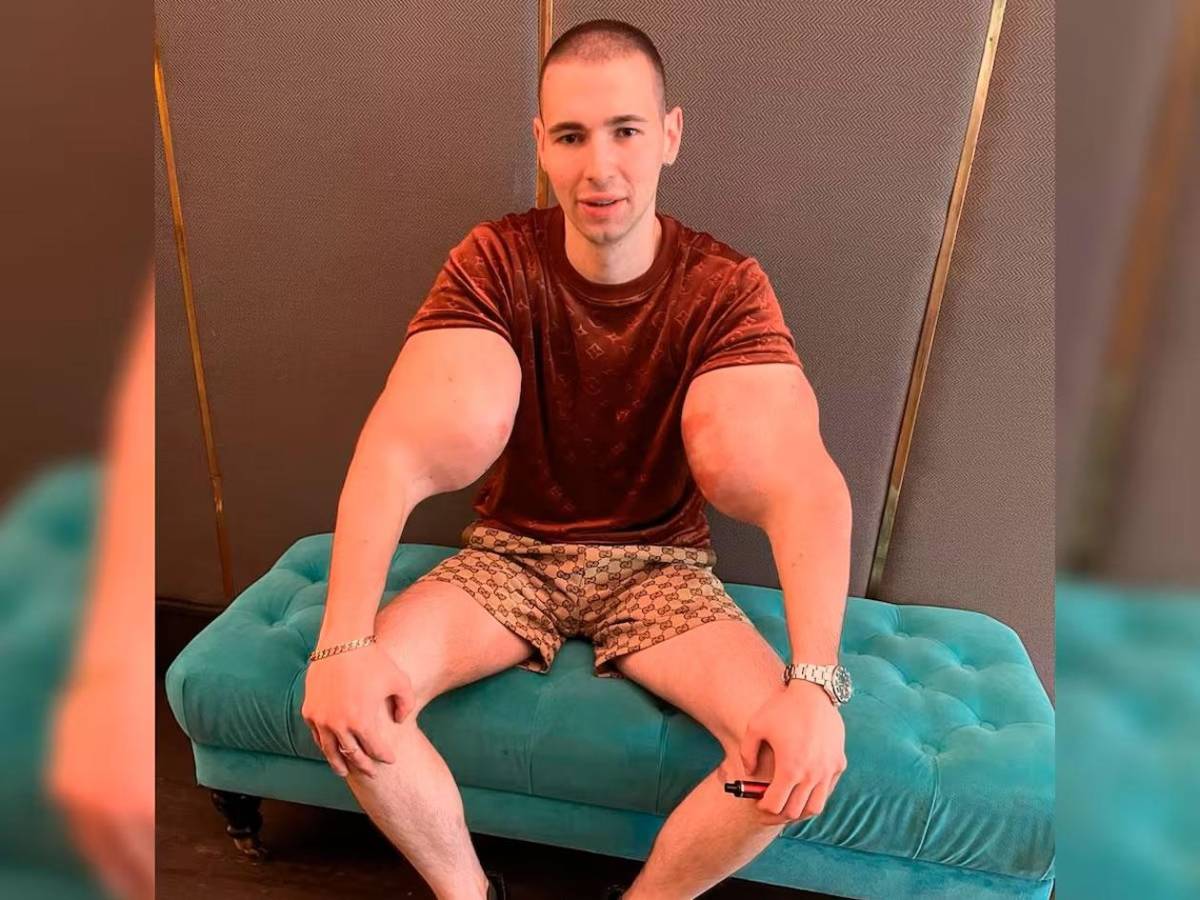 Deportista 'Popeye ruso' hace dramática confesión: podría perder los dos brazos
